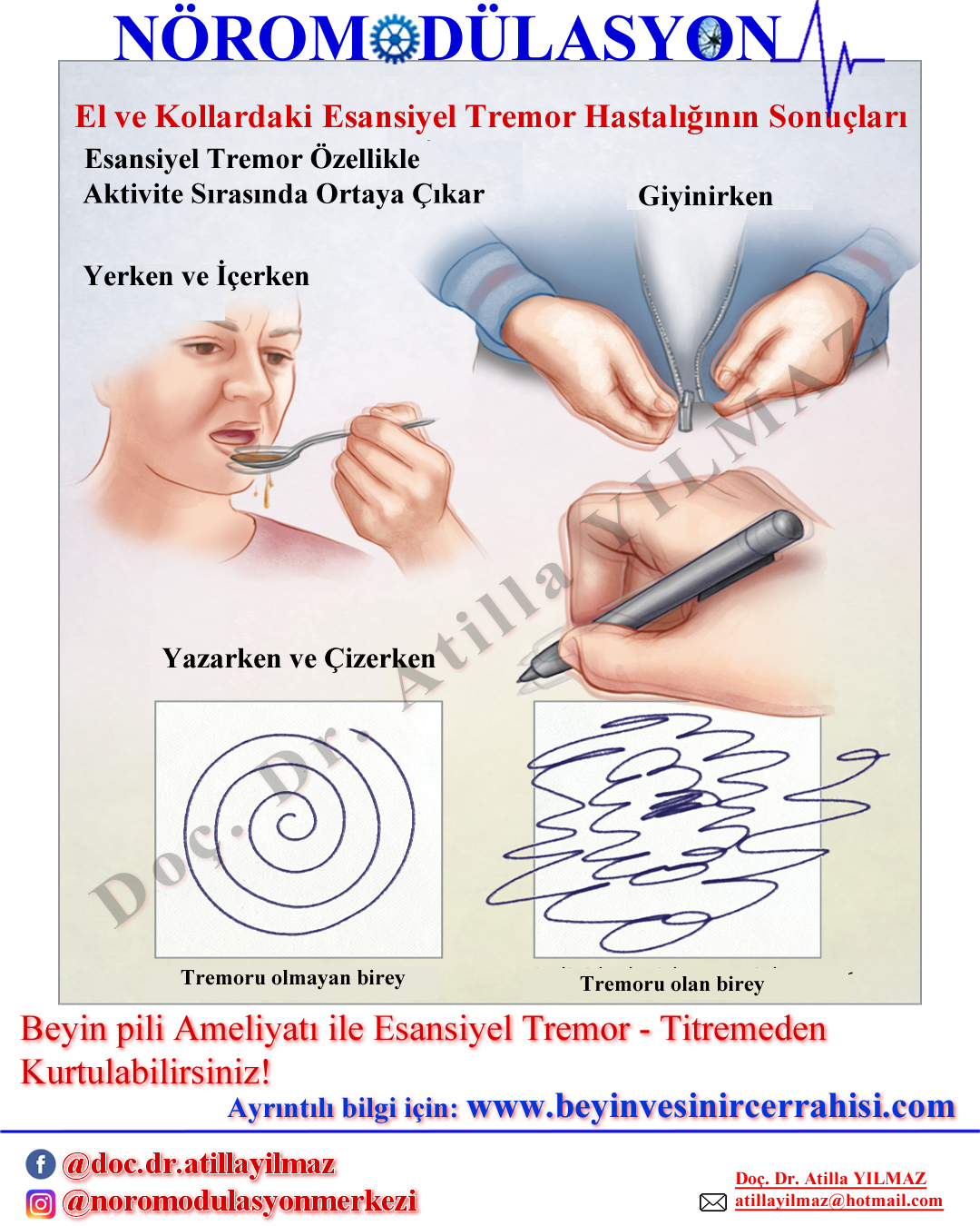 Esansiyel Tremor - Titreme