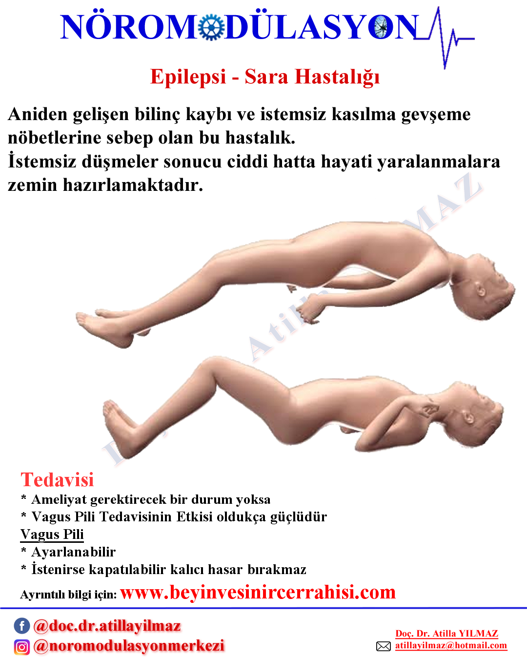 Epilepsi Sara Hastalığı 