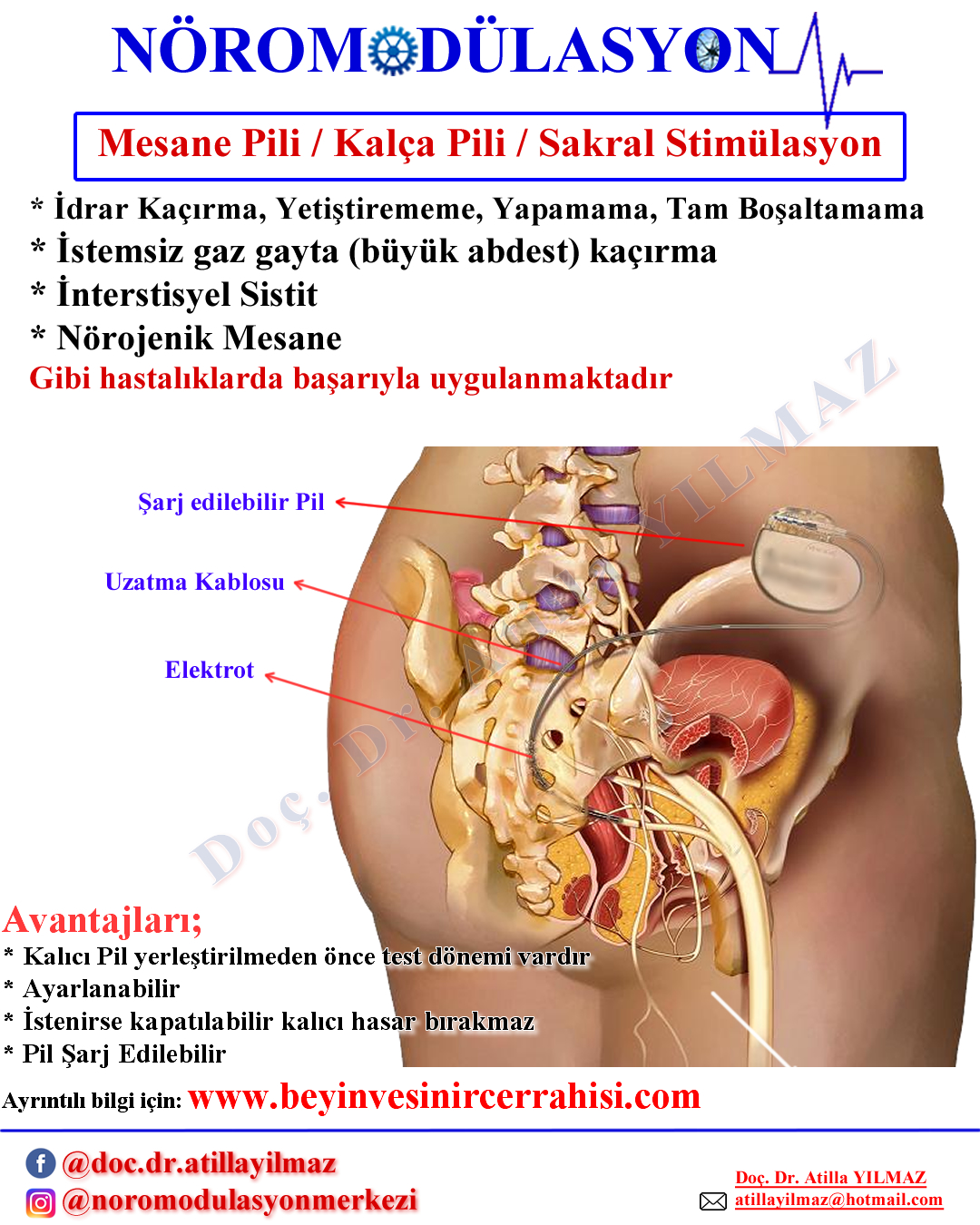 Sakral Stimülasyon - Mesane Pili