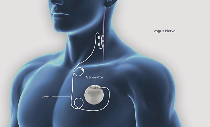 Vagal Sinir Stimülasyonu - Epilepsi Pili